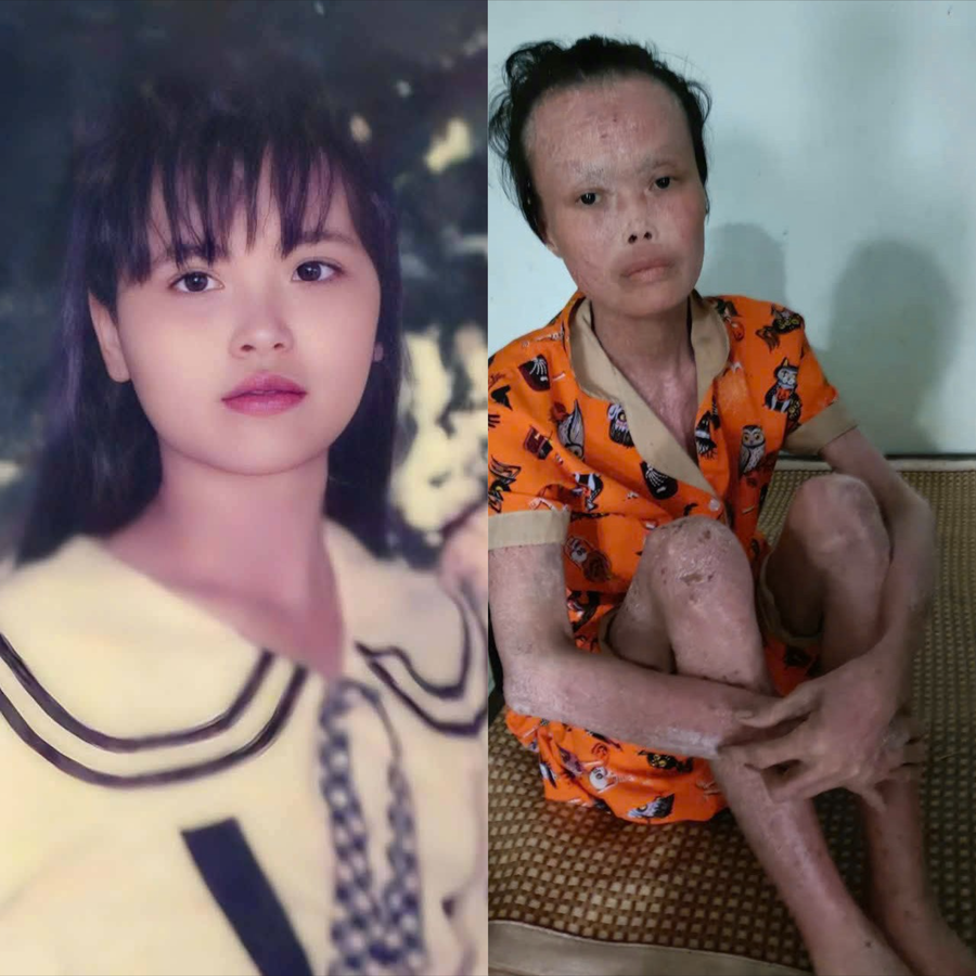 Căn bệnh vảy nến biến chứng biến cô Thương trở nên tiều tuỵ, hao mòn. co-thuong.png