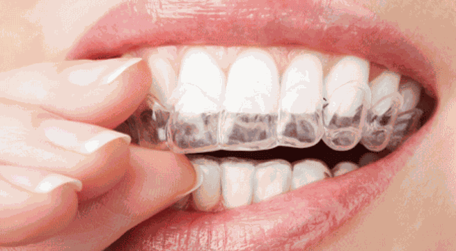 Tật nghiến răng và hậu quả nặng nề